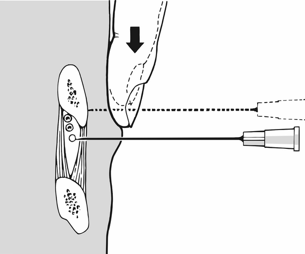Injektion an den Nervus intercostalis. Illustration: Lorenz Fischer, Thieme