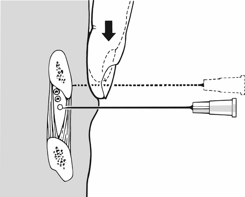 Injektion an den Nervus intercostalis. Illustration: Lorenz Fischer, Thieme