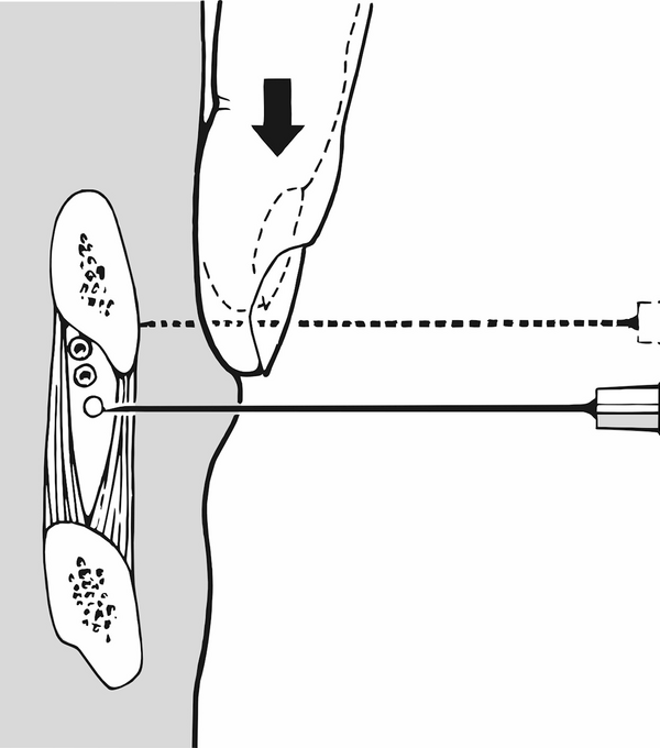 Injektion an den Nervus intercostalis. Illustration: Lorenz Fischer, Thieme