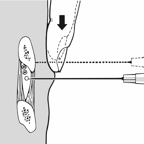 Injektion an den Nervus intercostalis. Illustration: Lorenz Fischer, Thieme