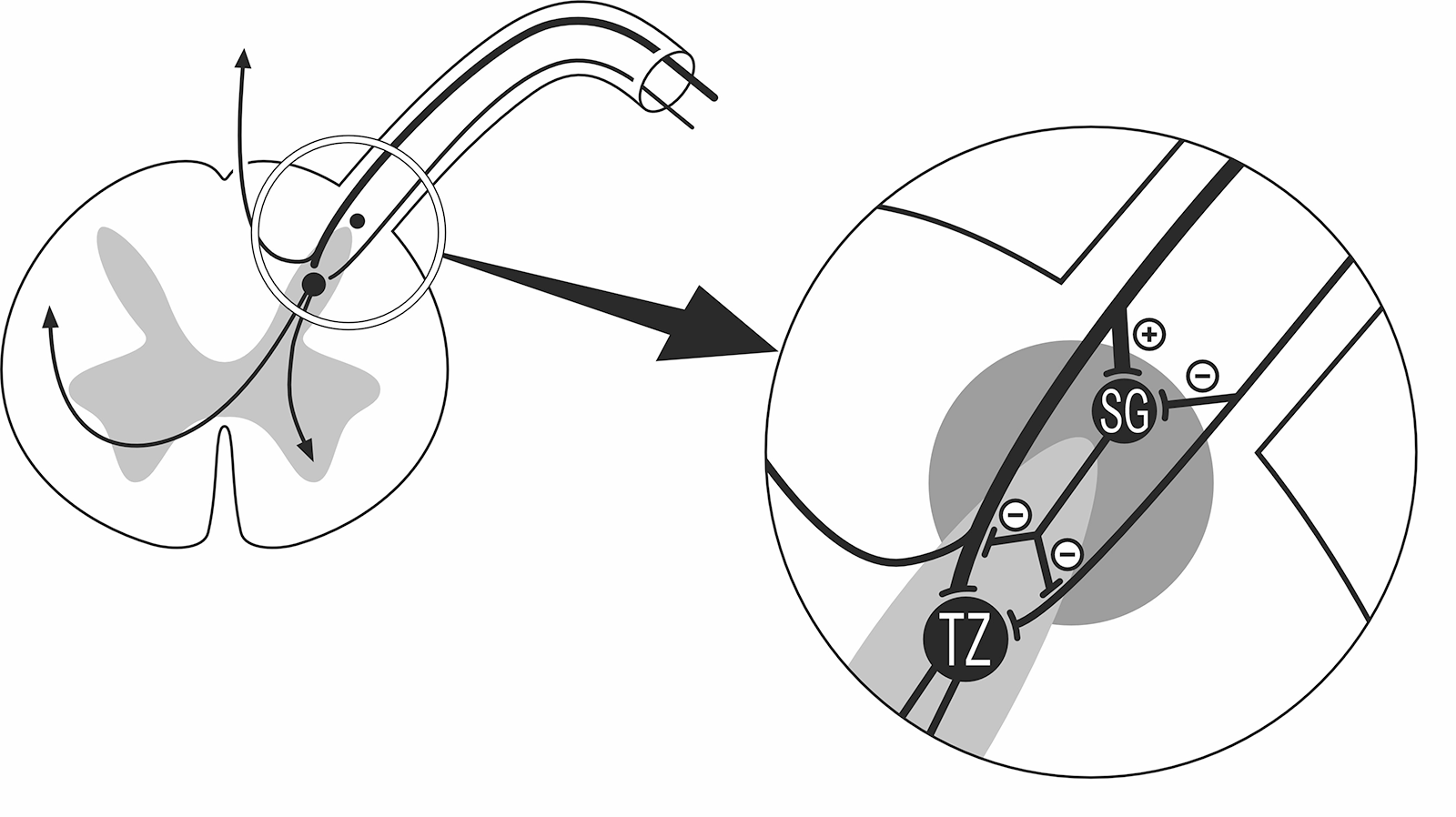 Die Gate-Control-Theorie nach Melzack und Wall, modifiziert. Illustration: Lorenz Fischer, Thieme.