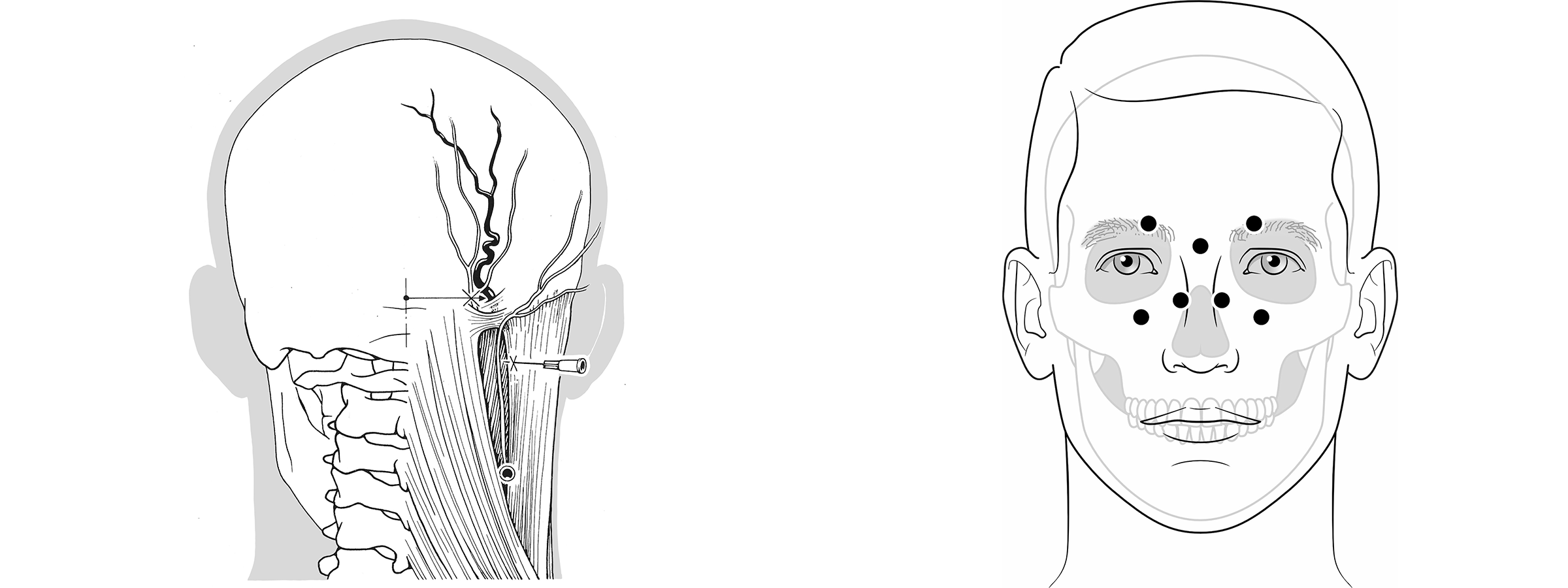 Injektionen an die Nervi occipitales major und minor und Injektionen an die Nervi supraorbitales und infraorbitales. Illustration: Lorenz Fischer, Thieme.