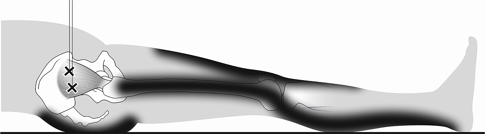 Injektionen an die Triggerpunkte Musculus gluteus medius. Illustration: Lorenz Fischer, Thieme.